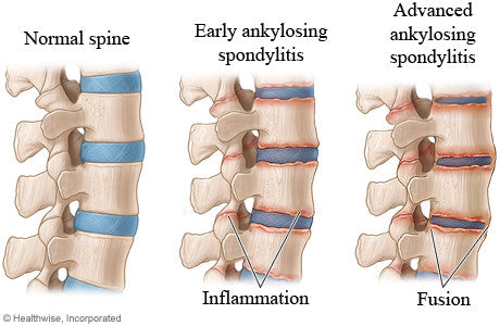 My Ankylosing Spondylitis (AS) in pregnancy was mistaken for Pelvic Girdle Pain (PGP)